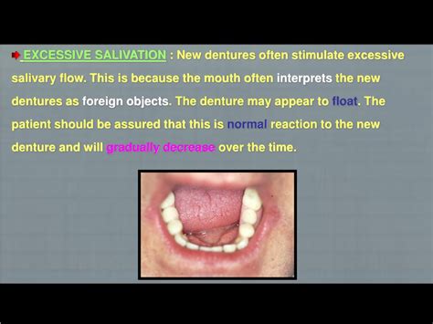 Ppt Try In Of Complete Denture Powerpoint Presentation Free Download Id9638087