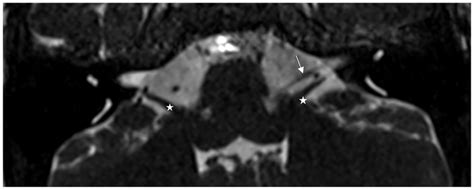 Axial Image Of High Resolution T2 Weighted Three Dimensional Sequence