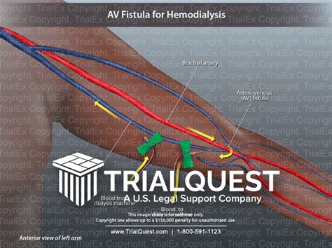 Dialysis Fistula