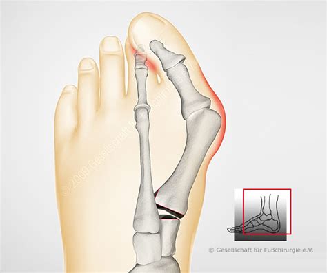 Hallux valgus Gesellschaft für Fuß und Sprunggelenkchirurgie e V