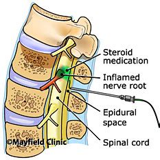 Epidural Injection for Back Pain | Singapore Sports & Orthopaedic Surgeon