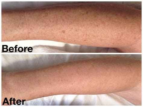 Sunspot Freckle Removal Denver Laser Solutions