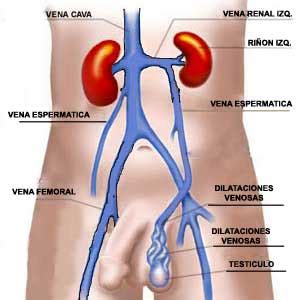 Cuando Operar El Varicocele Urolog A Peruana Dr Susan Bar