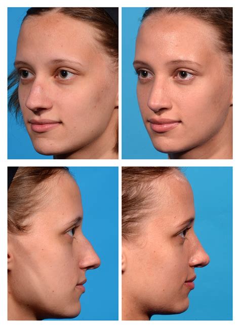 Rhinoplasty Before And After Photos