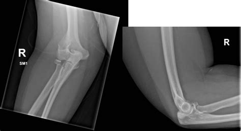 Radial Head Fracture | ENT ST3 Interview Preparation