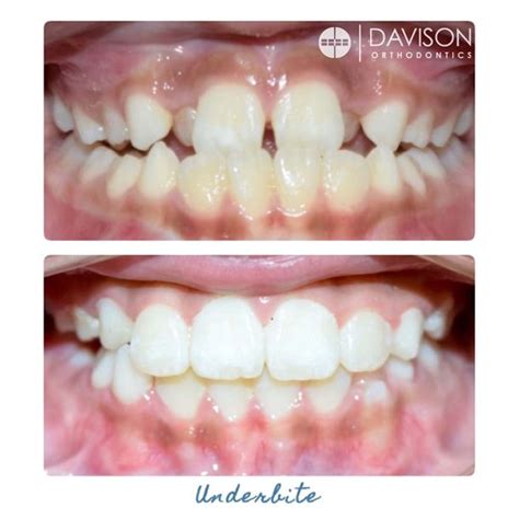 Smile Gallery Davison Orthodontics