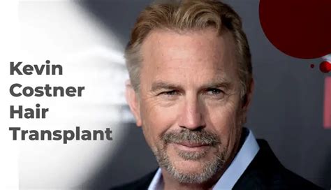 Kevin Costner Hair Transplant - Ekol Hospitals