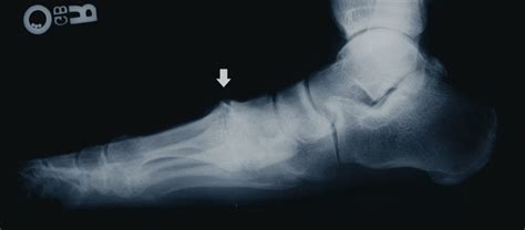 How To Fix Bone Spurs Comprehensive Guide To Bone Spurs Symptoms