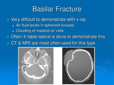 Basilar Skull Fracture Signs