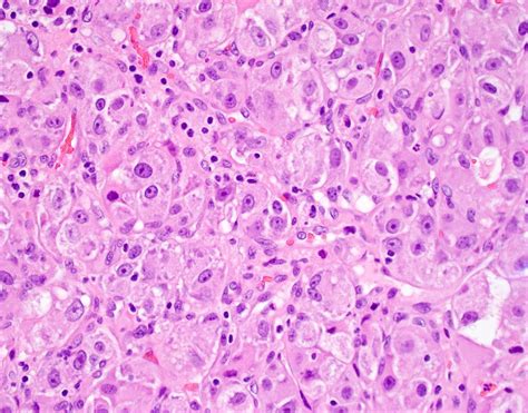 Alveolar Soft Part Sarcoma Market size, share & trends Analysis report ...