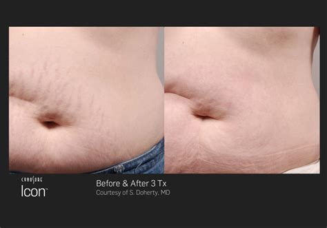 Stretch Mark Removal In Columbia SC Laser Stretch Mark Treatment