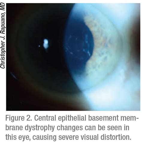 Anterior Basement Membrane Dystrophy Symptoms - Openbasement