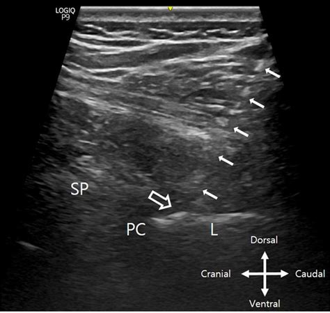 Real Time Ultrasound Guided Thoracic Epidural Catheterization A