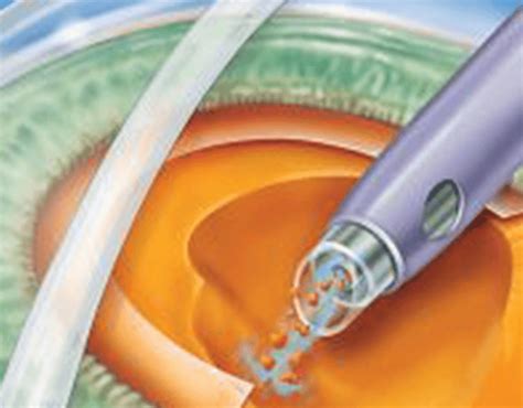 Cirurgia Clínica de Olhos Portão