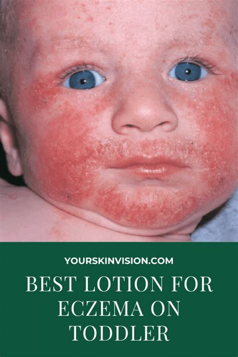 5 Best Lotion For Eczema On Toddler In 2024 Yourskinvision