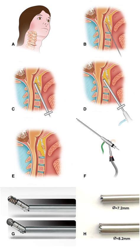 Frontiers Full Endoscopic Uniportal Retropharyngeal Odontoidectomy A