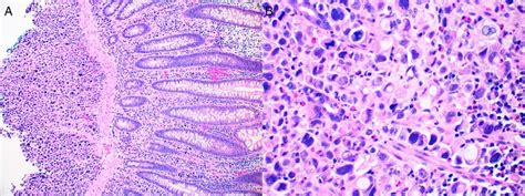 Histopathologic Findings Of Ulcer In The Ascending Colon Showing A Download Scientific