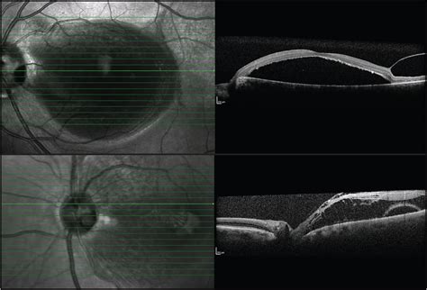 Treatment Of Optic Disk Pit Maculopathy Retinal Physician