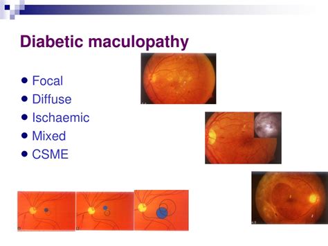 Ppt Clinical Features And Classification Of Diabetic Retinopathy