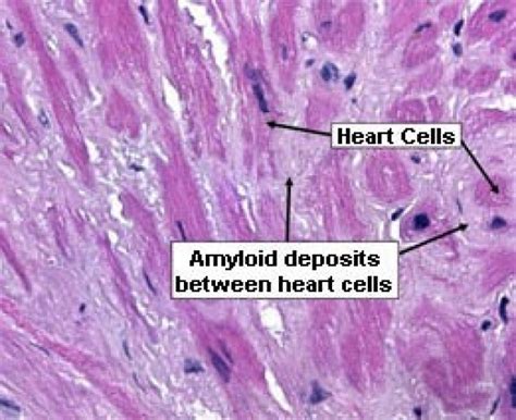 About Amyloidosis Amyloid Center Stanford Medicine