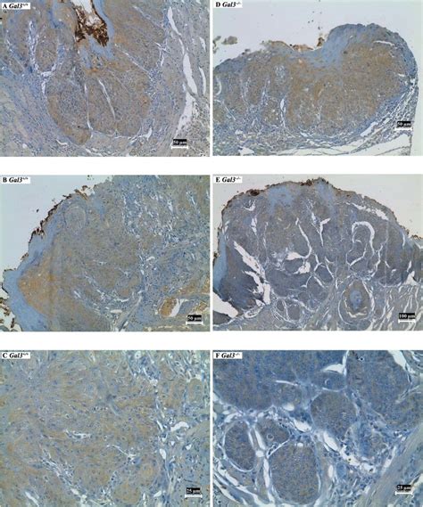 Immunohistochemical Staining Of Beta Catenin Expression A Severe Download Scientific Diagram