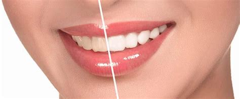 How To Keep Your Teeth White After Treatment Inna Trogan Dds