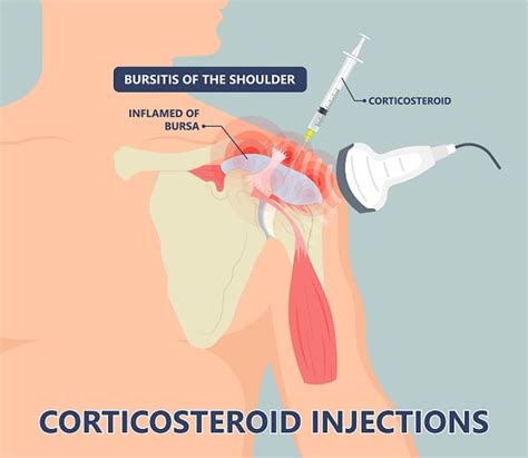 Shoulder Impingement Treatment In San Jose Dr Pamela Mehta