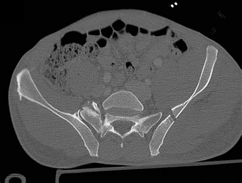 Complex Pelvic Fractures Including Sacrum Acetabulum And Femur With A Normal Ct Cystogram