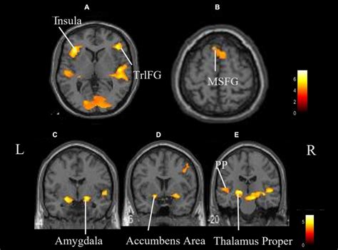 Whole Brain Activation While Listening To Asmr Compared With The