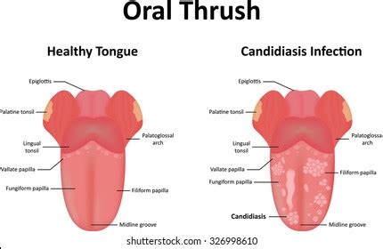 signs of thrush in mouth Cheaper Than Retail Price> Buy Clothing ...