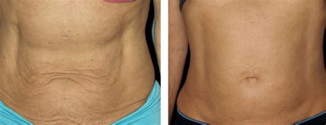 thermage    belly thermage