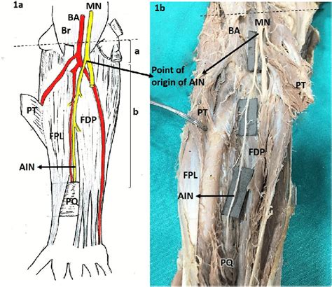 a: Drawing showing the origin and course of the AIN in the forearm Fig.... | Download Scientific ...