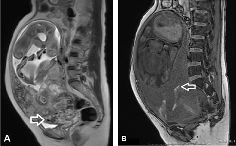 A 26 Year Old Woman Performed In 2 Times Of Mri A At Ga 23 Weeks Download Scientific