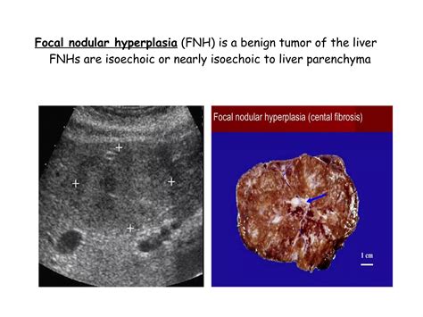 Liver Ultrasound | PPT