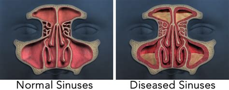 Sinus Anatomy Drainage Anatomical Charts And Posters