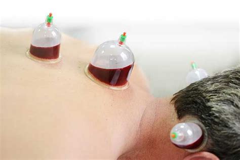 Cupping Therapy Types Benefits And Adverse Effect How To Relief Wet