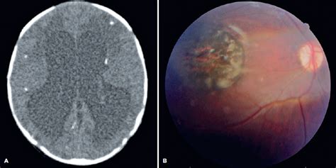 Scielo Brasil Congenital Ocular Toxoplasmosis In Consecutive