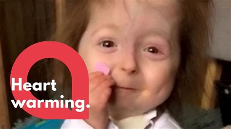 Little Girl With Rare Benjamin Button Disease Makes A Paper Heart For