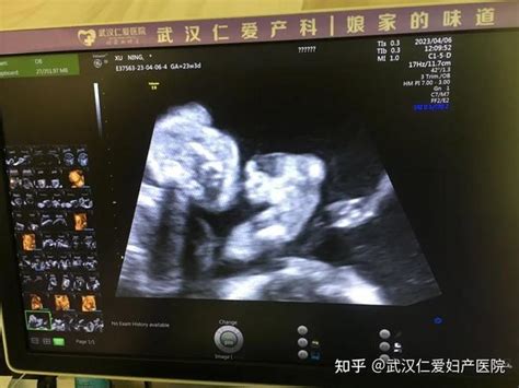 三胞胎孕妈粗心弄错产检时间，仁爱四维排畸精准查出胎儿异常！ 知乎