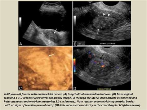 Endometrial Cancer Ultrasound