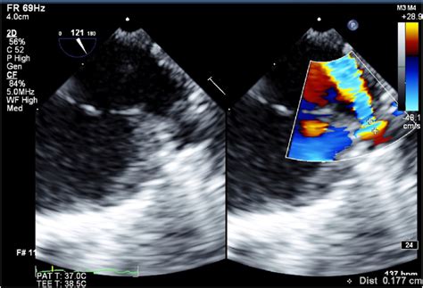 Two Dimensional Transesophageal Echocardiography Midesophageal Download Scientific Diagram