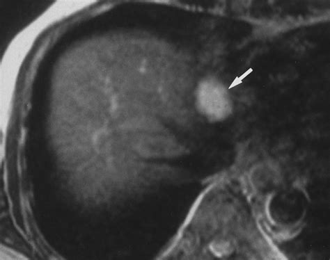 Single Breath Hold T2 Weighted MR Imaging Of The Liver Value Of Single