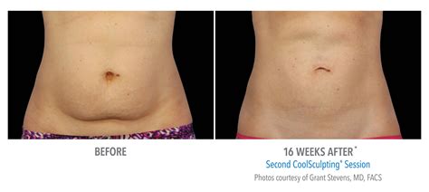 CoolSculpting Delray Beach, FL | Delray Dermatology + Cosmetic Center