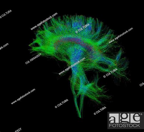 Diffusion Mri Also Referred To As Diffusion Tensor Imaging Or Dti Of