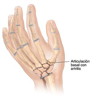 Qu Es La Artritis De La Articulaci N Basal Northwestern Medicine