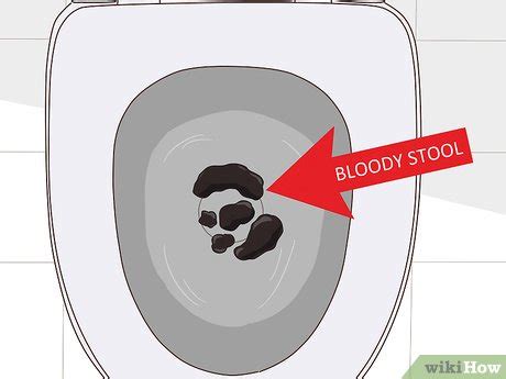 How to Treat a Bleeding Ulcer: 14 Steps (with Pictures) - wikiHow