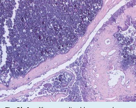 Figure From Tumoral Calcinosis Of The Gluteal Region In A Year Old