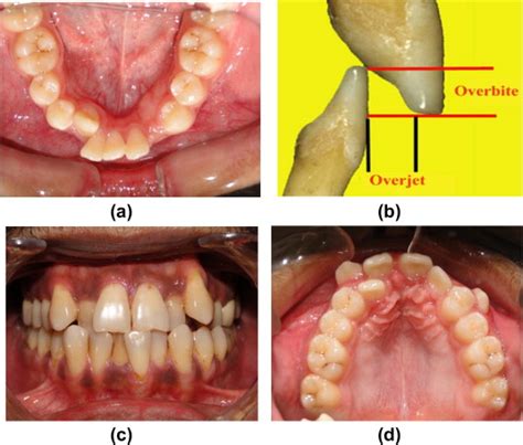 Occlusal Traits A Missing And Un Erupted Teeth B Overjet And Download Scientific Diagram