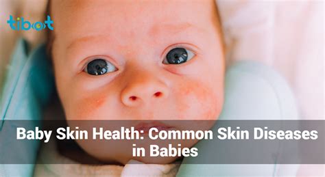 Baby Skin Health Common Skin Diseases In Babies Tibot