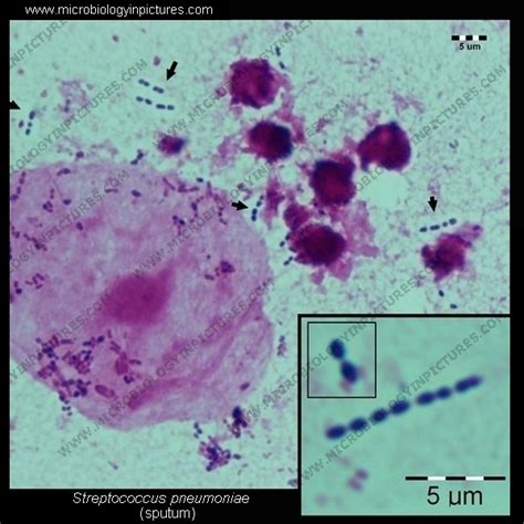 Pneumococcus (S.pneumoniae) microscopy. Pneumococcus Gram-stain and cell morphology ...